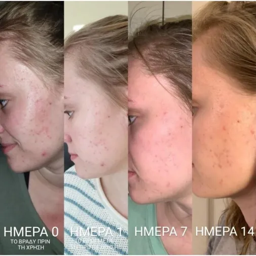 Κεραλοιφή για Ακμή και Σπυράκια 30ml Bee Factor 